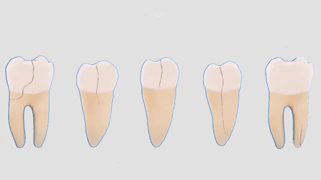 Cracked Teeth Image Gray