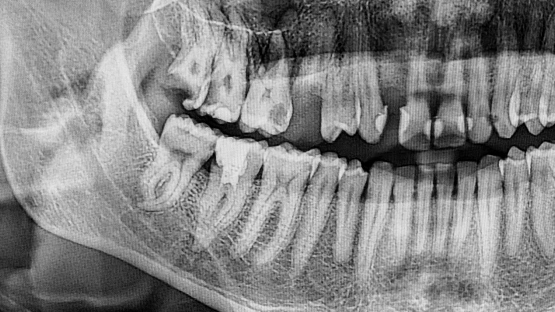 Resorption Image